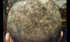 頭皮癬跟頭皮屑有區(qū)別嗎 頭皮屑和頭皮癬的區(qū)別是什么